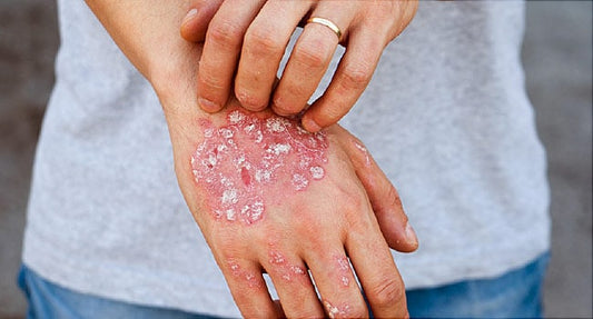 Break free from eczema with Crypto PPARs.