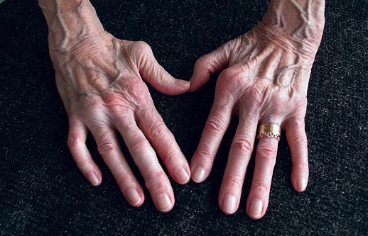 All you need to know about Rheumatoid arthritis