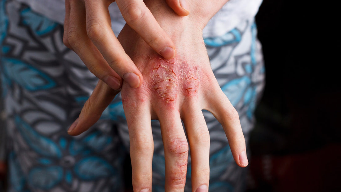 Surviving eczema days